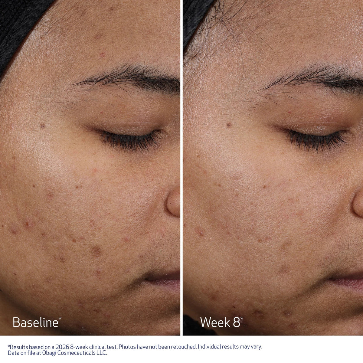 Clenziderm Resurfacing Multi-Acid Peel Pads